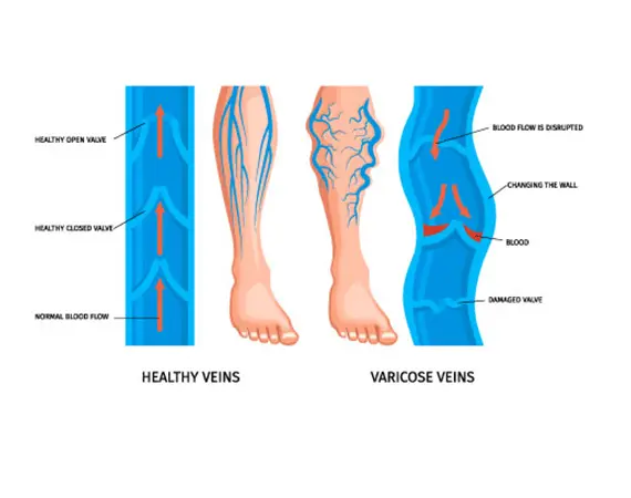 varicose veins