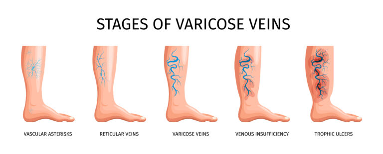 Varicose Veins Stages