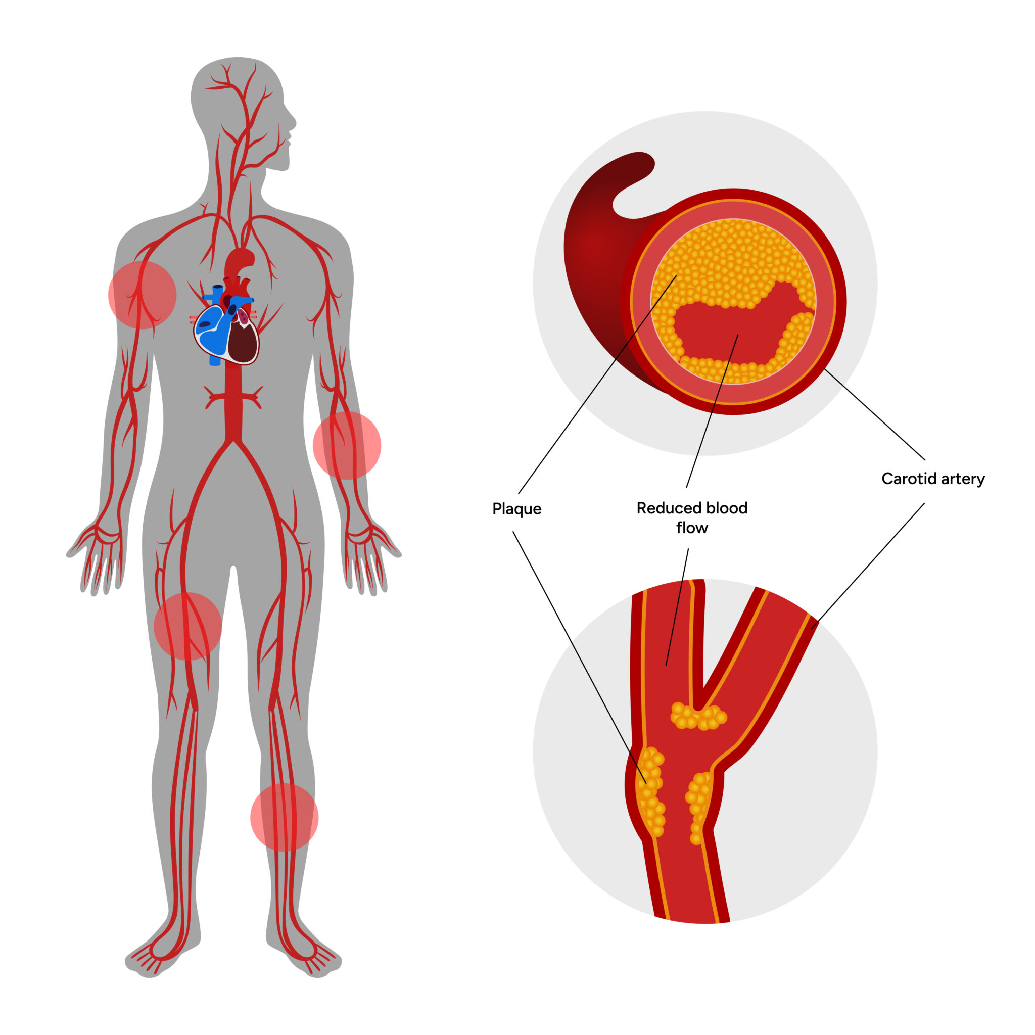 Peripheral Artery Disease (PAD) Treatment Bangalore
