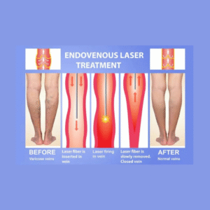 EVLT laser treatment for varicose veins procedure