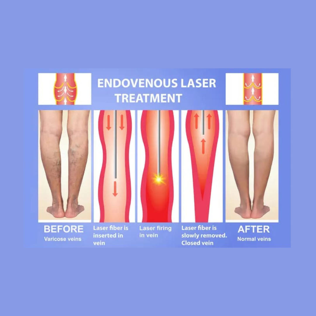 EVLT laser treatment for varicose veins procedure