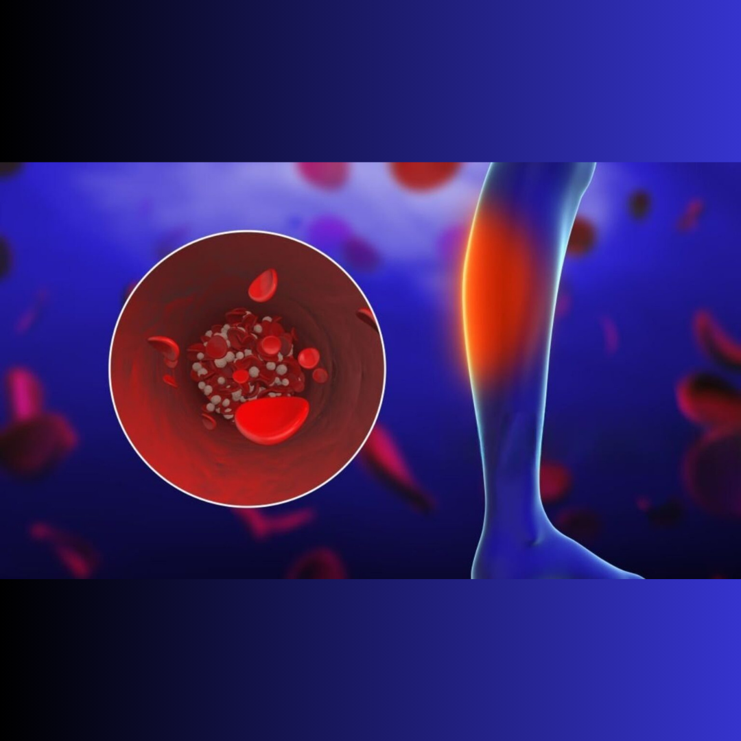 deep vein thrombosis blood clot in leg vein