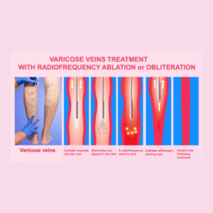radiofrequency ablation treatment for varicose veins in Bangalore