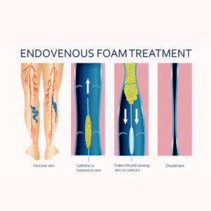 sclerotherapy treatment for spider veins and small varicose veins