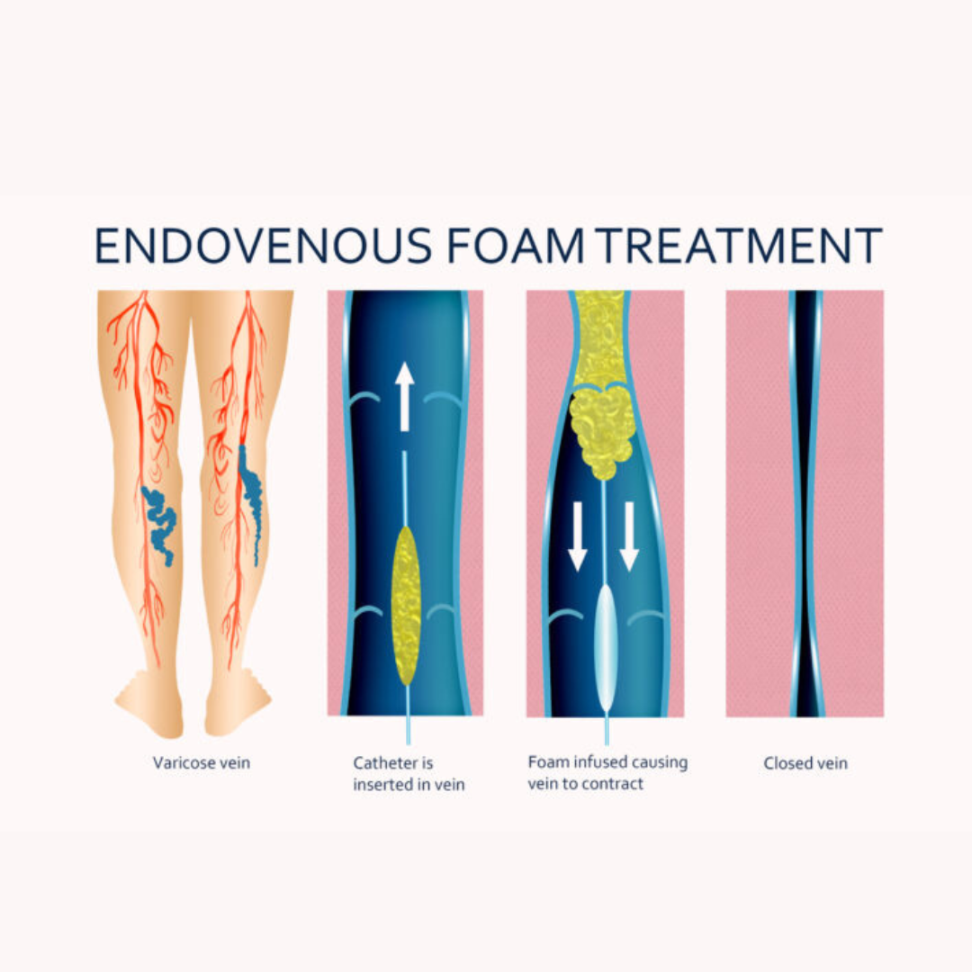 sclerotherapy treatment for spider veins and small varicose veins