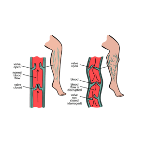 bulging varicose veins in legs requiring vein treatment