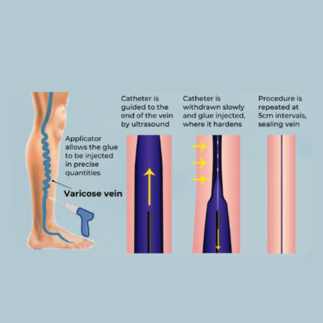 VenaSeal medical adhesive treatment for varicose veins